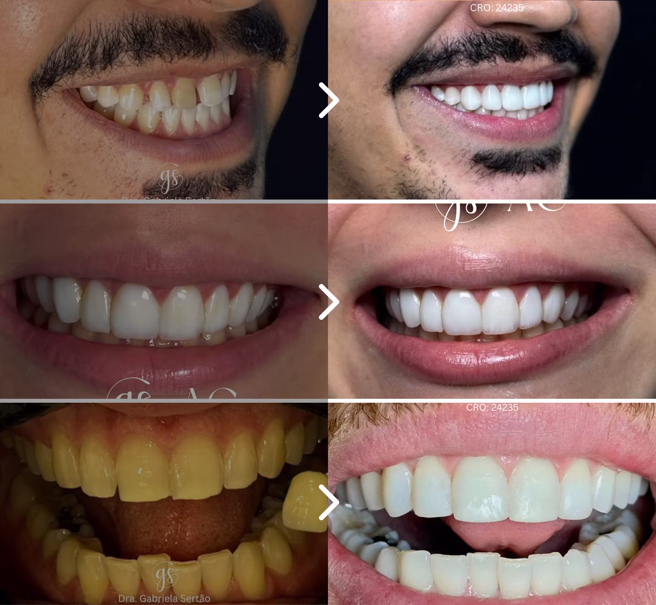 Sorriso com dentes brancos após clareamento dentário profissional